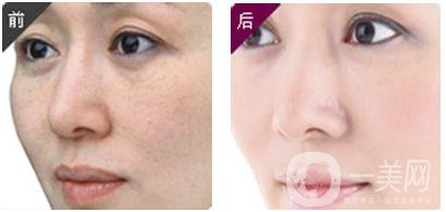 黑臉娃娃做一次多少錢 正規(guī)醫(yī)院收費(fèi)多少錢？