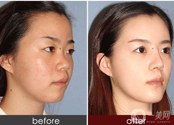 *,術(shù)后注意事項(xiàng)