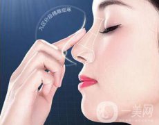 朝天鼻怎么矯正 朝天鼻矯正方法