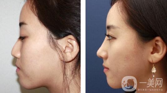 *術(shù)后要忌口嗎？術(shù)后注意事項(xiàng)有哪些？