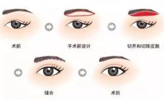 廣東眉整形價(jià)格多少 眉整形要多少錢