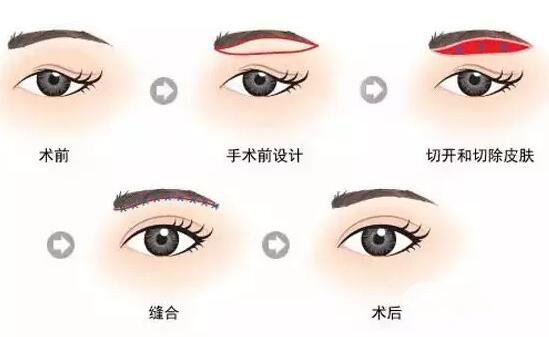 廣東眉整形價(jià)格多少 眉整形要多少錢