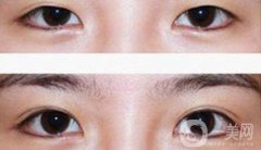 八月割雙眼皮會發(fā)炎嗎 雙眼皮術(shù)后護(hù)理事項介紹