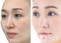 嫩膚多少錢 醫(yī)療美容嫩膚價(jià)格詳解