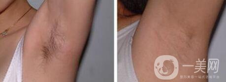 激光脫毛價格在多少 激光脫毛費用詳解