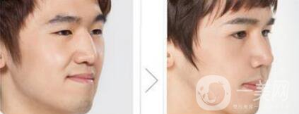 鷹鉤鼻矯正過(guò)程 鷹鉤鼻矯正是怎么做的