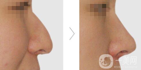 鷹鉤鼻矯正過(guò)程 鷹鉤鼻矯正是怎么做的