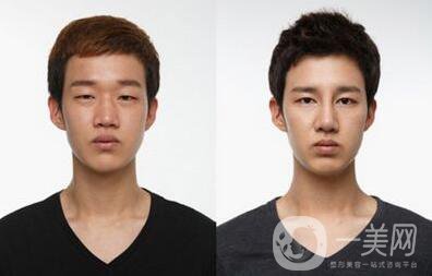 男生割雙眼皮會變帥嗎？