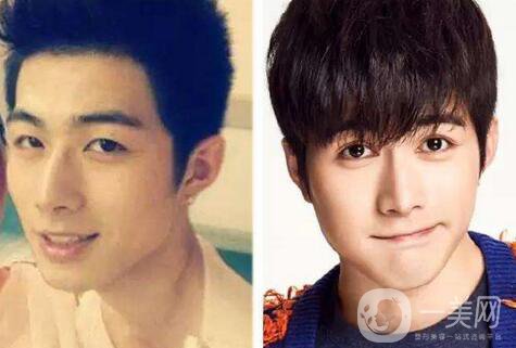 男生割雙眼皮會變帥嗎？