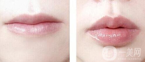 豐唇需要多少錢(qián) 豐唇價(jià)格詳解