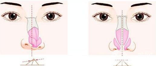 鼻子歪了矯正有危險(xiǎn)嗎？