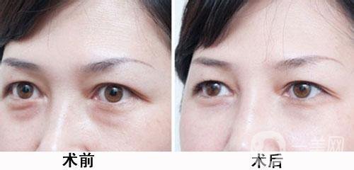 超聲波去眼袋大概多少價格 費用詳情一覽