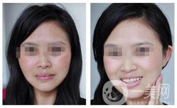 如何去除妊娠斑 去妊娠斑多少錢