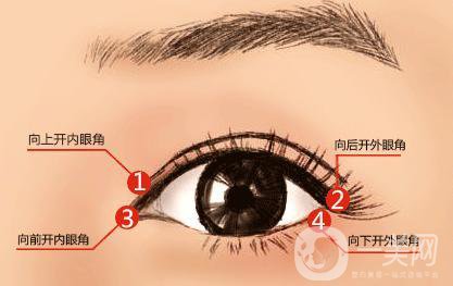 什么人適合做開(kāi)眼角手術(shù)？