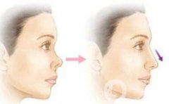 矯正朝天鼻多少錢 朝天鼻矯正價格詳解