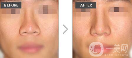 矯正朝天鼻多少錢 朝天鼻矯正價格詳解