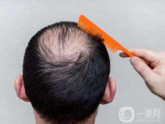 fut植發(fā)技術(shù)怎么樣 fut植發(fā)技術(shù)好不好