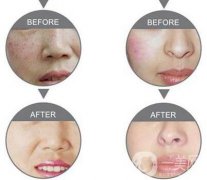 果酸換膚果怎么樣 果酸換膚*嗎