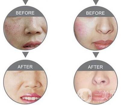 果酸換膚*果怎么樣 果酸換膚*嗎