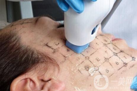 塑美極*果怎么樣 塑美極能除皺嗎