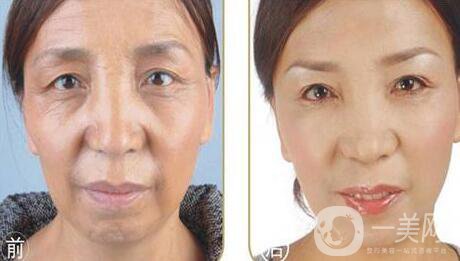 塑美極*果怎么樣 塑美極能除皺嗎