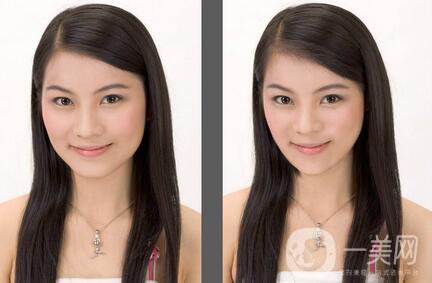 下頜角截骨手術(shù)會復(fù)發(fā)嗎？