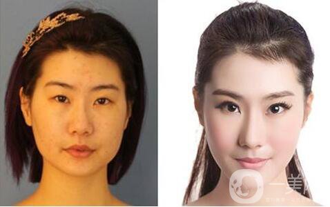 下頜角截骨手術(shù)會復(fù)發(fā)嗎？