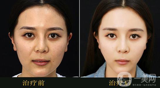 醫(yī)院果酸換膚多少錢 價格詳情