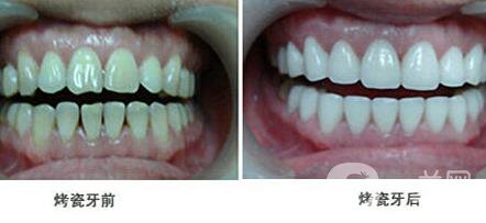 上海鈷鉻烤瓷牙價格 鈷鉻烤瓷牙要多少錢