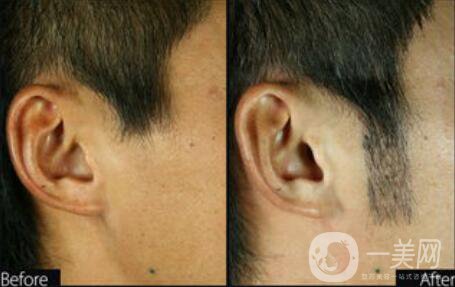 植鬢角大概多少錢 鬢角種植價(jià)格詳解