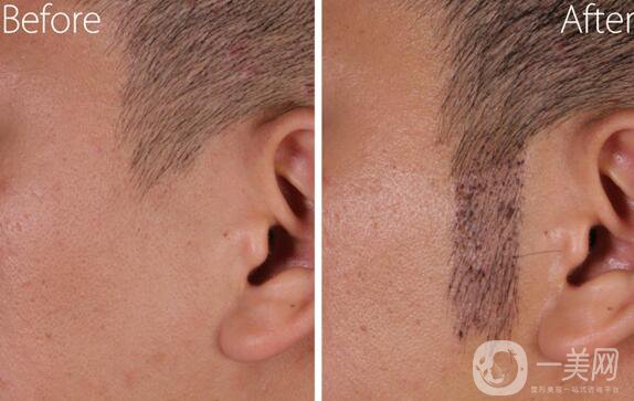 植鬢角大概多少錢 鬢角種植價(jià)格詳解