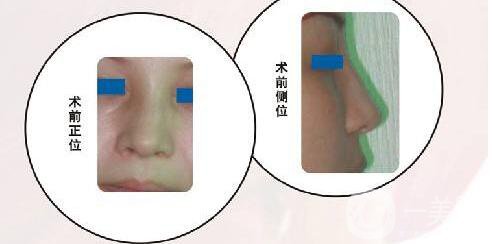 廣東,鼻骨矯正術(shù),多少錢