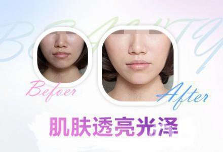 果酸換膚的功* 有哪些好處？