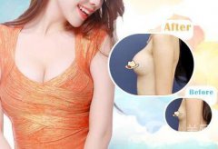 隆胸術(shù)后的后遺癥有哪些 隆胸有哪些風險