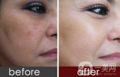 去黃褐斑多少錢 去除黃褐斑價格介紹