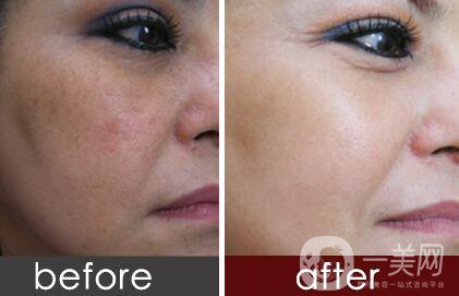 去黃褐斑多少錢 去除黃褐斑價(jià)格介紹