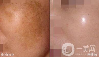 去黃褐斑多少錢 去除黃褐斑價(jià)格介紹
