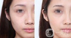 光子嫩膚管用嗎 光子嫩膚有什么果