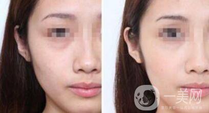 光子嫩膚管用嗎 光子嫩膚有什么*果