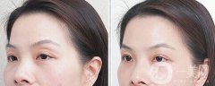 自體脂肪豐眼窩缺點 自體脂肪豐眼窩為什么不好