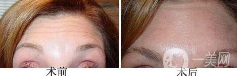 去除抬頭紋的價錢 去抬頭紋大概多少錢