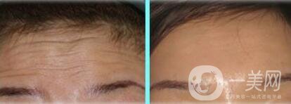 去除抬頭紋的價錢 去抬頭紋大概多少錢