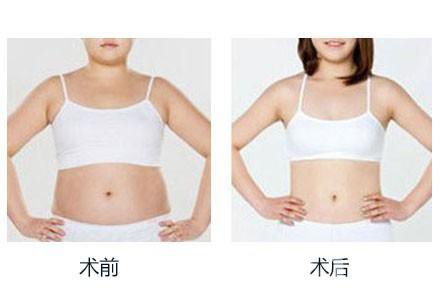 360度環(huán)形吸脂有哪些術(shù)后注意事項？
