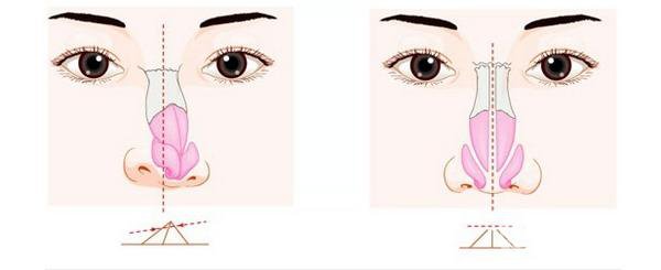 做一次歪鼻矯正手術(shù)價格需要多少錢？