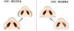 蒜頭鼻整形要多少錢 蒜頭鼻整形價格