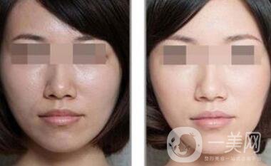 飛頓彩光嫩膚*果如何 飛頓彩光嫩膚前后圖