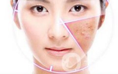 做果酸換膚多少錢一次 果酸換膚具體價格