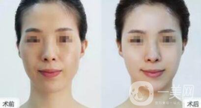 豐太陽穴多少錢 太陽穴填充具體價格