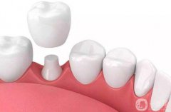 貴金屬烤瓷牙多少錢一顆 貴金屬烤瓷牙一顆的價格