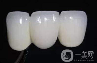 貴金屬,烤瓷牙,多少錢